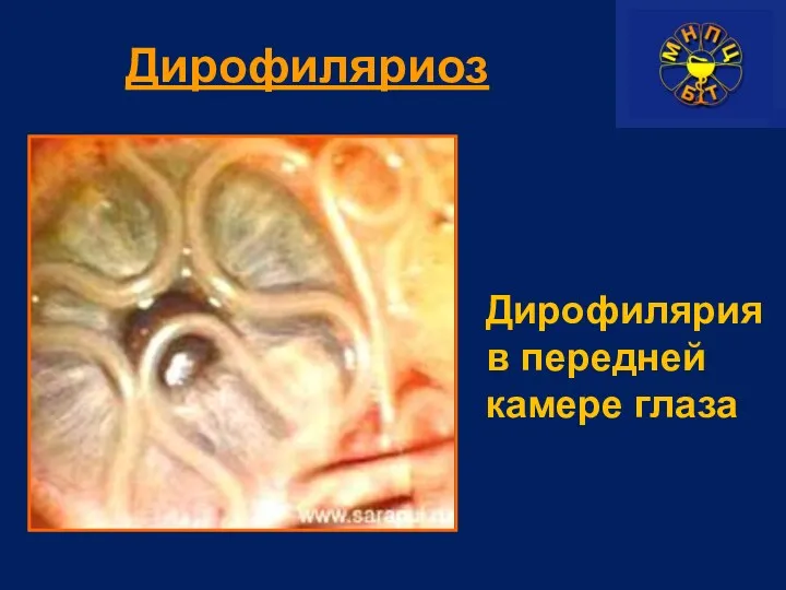 Дирофиляриоз Дирофилярия в передней камере глаза