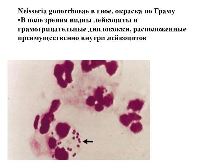 Neisseria gonorrhoeae в гное, окраска по Граму •В поле зрения