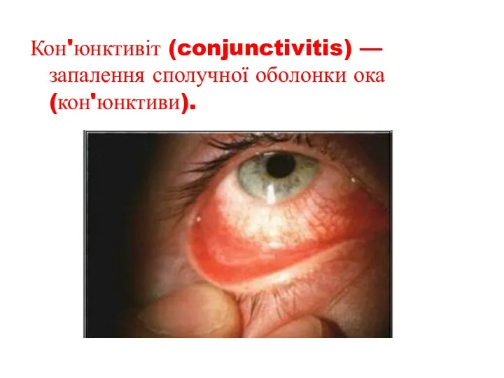 Кон'юнктивіт (conjunctivitis) — запалення сполучної оболонки ока (кон'юнктиви).