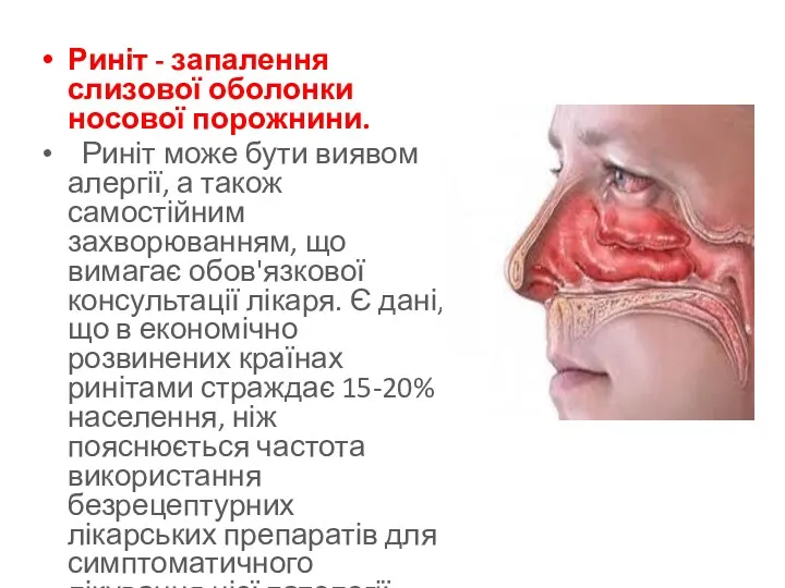 Риніт - запалення слизової оболонки носової порожнини. Риніт може бути виявом алергії, а