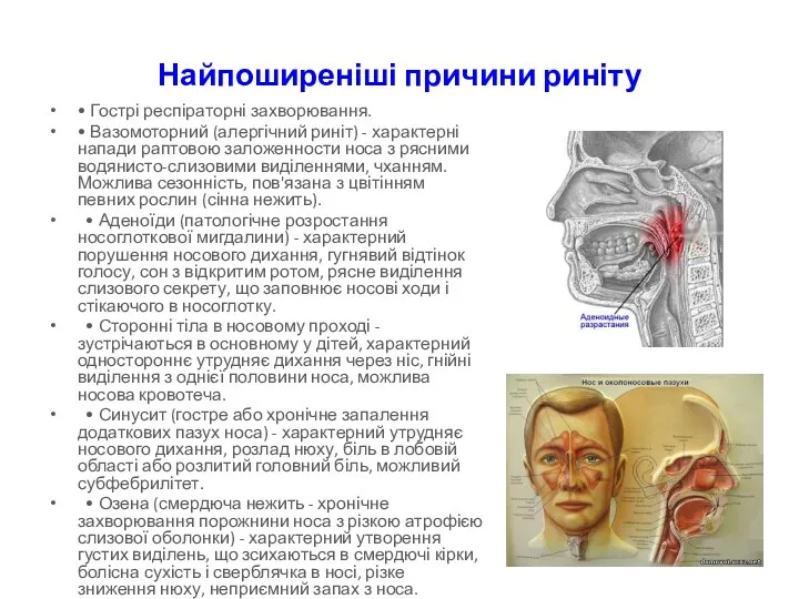 Найпоширеніші причини риніту • Гострі респіраторні захворювання. • Вазомоторний (алергічний риніт) - характерні