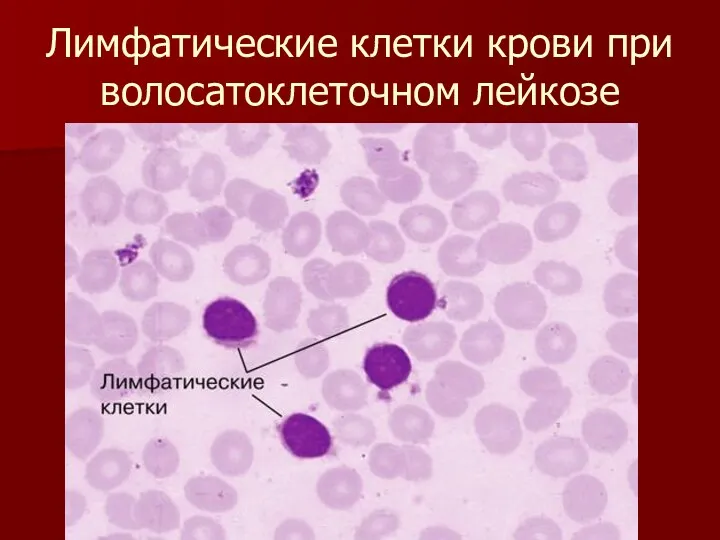 Лимфатические клетки крови при волосатоклеточном лейкозе