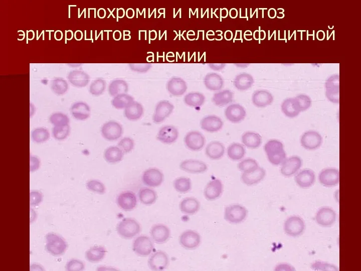 Гипохромия и микроцитоз эритороцитов при железодефицитной анемии