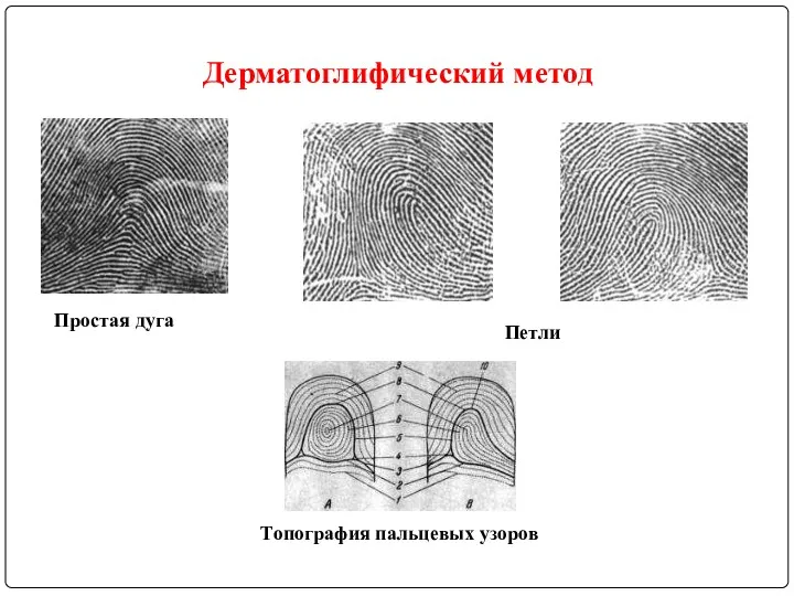 Простая дуга Петли Топография пальцевых узоров Дерматоглифический метод