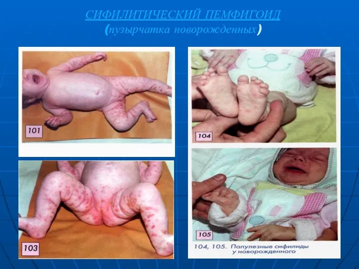 СИФИЛИТИЧЕСКИЙ ПЕМФИГОИД (пузырчатка новорожденных)