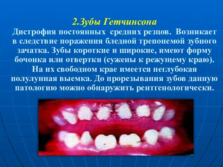 2.Зубы Гетчинсона Дистрофия постоянных средних резцов. Возникает в следствие поражения бледной трепонемой зубного
