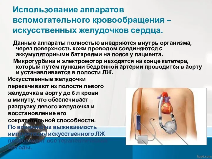 Использование аппаратов вспомогательного кровообращения – искусственных желудочков сердца. Данные аппараты