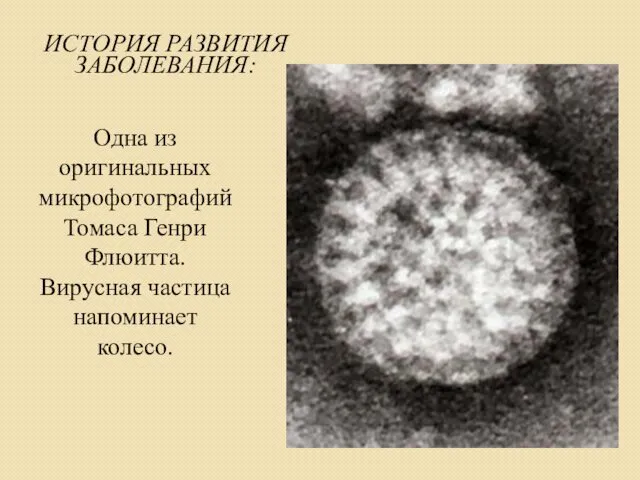 ИСТОРИЯ РАЗВИТИЯ ЗАБОЛЕВАНИЯ: Одна из оригинальных микрофотографий Томаса Генри Флюитта. Вирусная частица напоминает колесо.