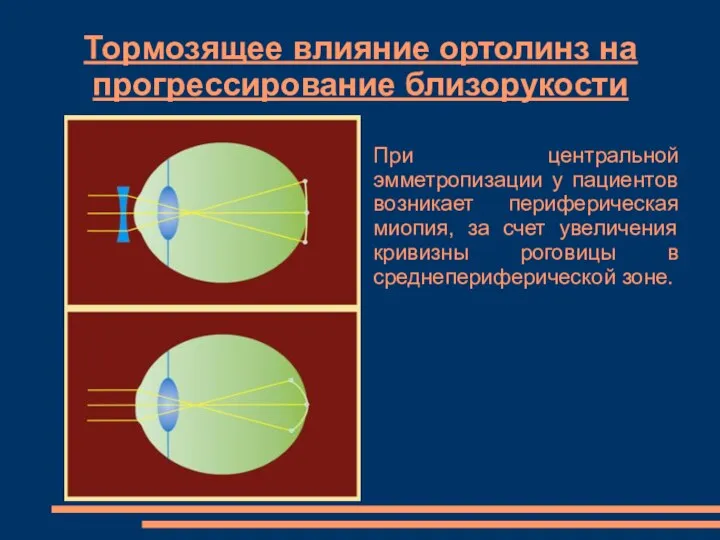 Тормозящее влияние ортолинз на прогрессирование близорукости При центральной эмметропизации у пациентов возникает периферическая