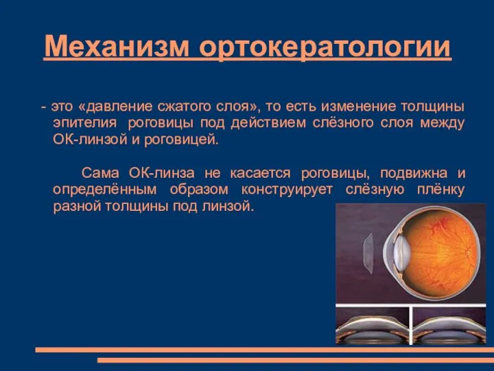 Механизм ортокератологии - это «давление сжатого слоя», то есть изменение толщины эпителия роговицы