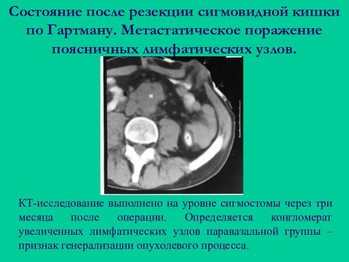 Состояние после резекции сигмовидной кишки по Гартману. Метастатическое поражение поясничных