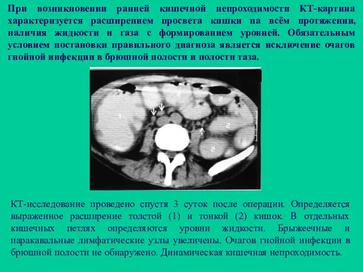 При возникновении ранней кишечной непроходимости КТ-картина характеризуется расширением просвета кишки