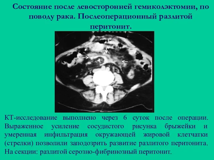 Состояние после левосторонней гемиколэктомии, по поводу рака. Послеоперационный разлитой перитонит.