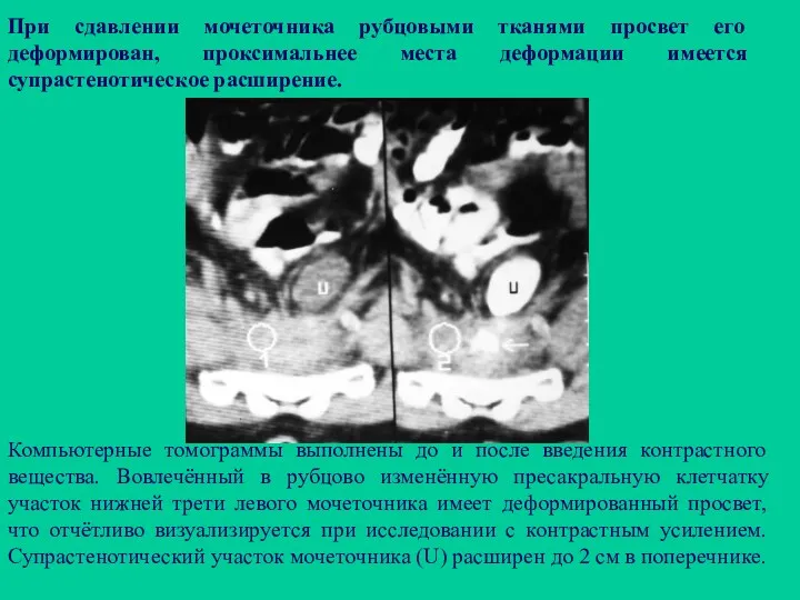 При сдавлении мочеточника рубцовыми тканями просвет его деформирован, проксимальнее места