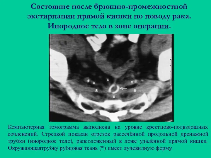 Состояние после брюшно-промежностной экстирпации прямой кишки по поводу рака. Инородное