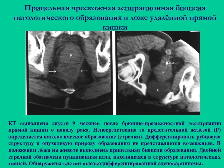 Прицельная чрескожная аспирационная биопсия патологического образования в ложе удалённой прямой