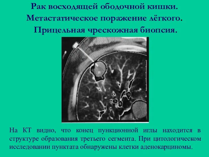 Рак восходящей ободочной кишки. Метастатическое поражение лёгкого. Прицельная чрескожная биопсия.