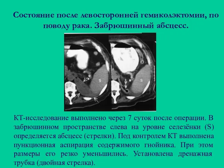 Состояние после левосторонней гемиколэктомии, по поводу рака. Забрюшинный абсцесс. КТ-исследование