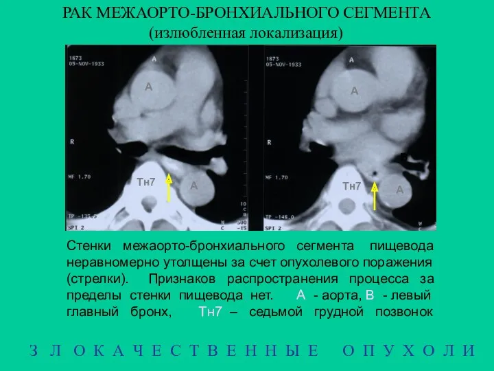 РАК МЕЖАОРТО-БРОНХИАЛЬНОГО СЕГМЕНТА (излюбленная локализация) З Л О К А