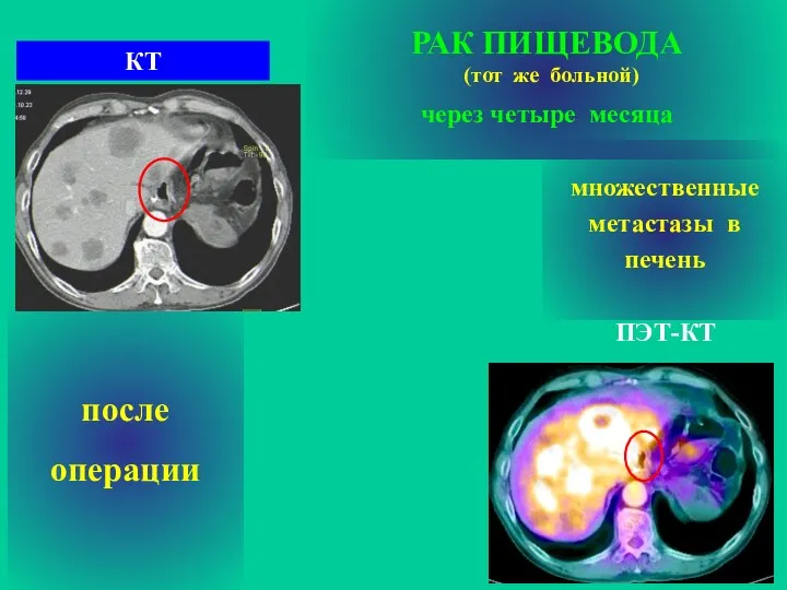 РАК ПИЩЕВОДА (тот же больной) через четыре месяца после операции ПЭТ-КТ КТ множественные метастазы в печень