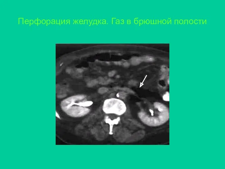 Перфорация желудка. Газ в брюшной полости