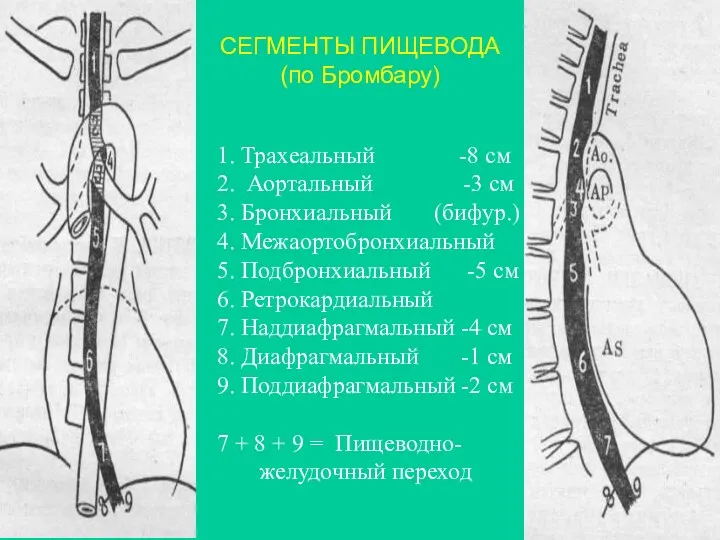 1. Трахеальный -8 см 2. Аортальный -3 см 3. Бронхиальный