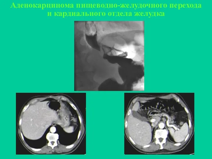 Аденокарцинома пищеводно-желудочного перехода и кардиального отдела желудка