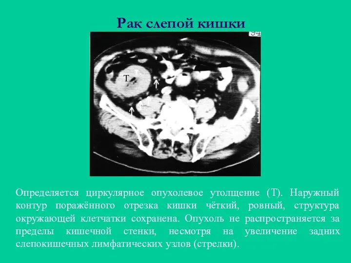 Рак слепой кишки Определяется циркулярное опухолевое утолщение (Т). Наружный контур