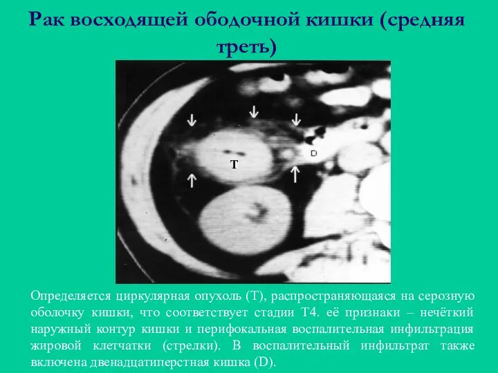 Рак восходящей ободочной кишки (средняя треть) Определяется циркулярная опухоль (Т),