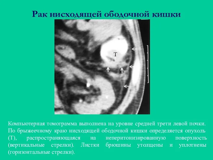 Рак нисходящей ободочной кишки Компьютерная томограмма выполнена на уровне средней