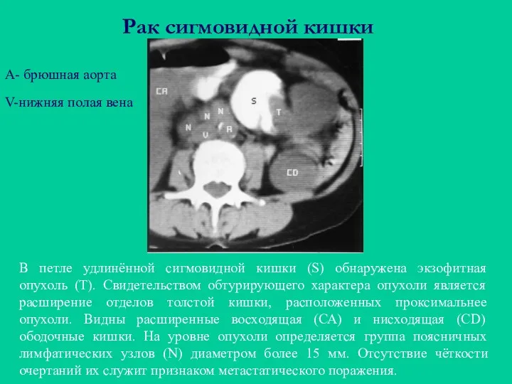 Рак сигмовидной кишки В петле удлинённой сигмовидной кишки (S) обнаружена