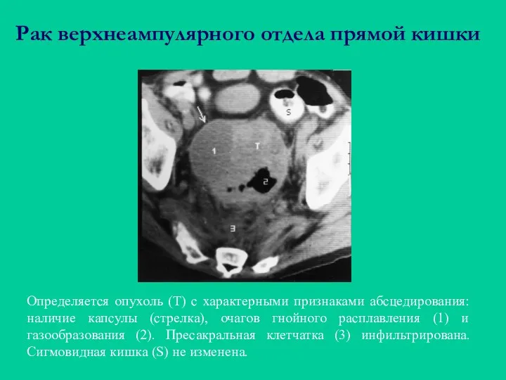 Рак верхнеампулярного отдела прямой кишки Определяется опухоль (Т) с характерными