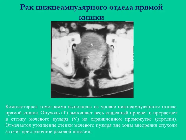 Рак нижнеампулярного отдела прямой кишки Компьютерная томограмма выполнена на уровне