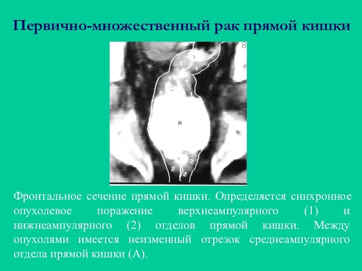 Первично-множественный рак прямой кишки Фронтальное сечение прямой кишки. Определяется синхронное