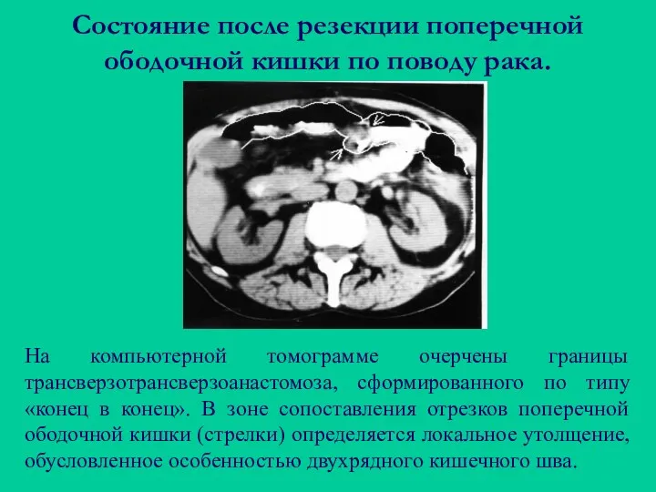 Состояние после резекции поперечной ободочной кишки по поводу рака. На