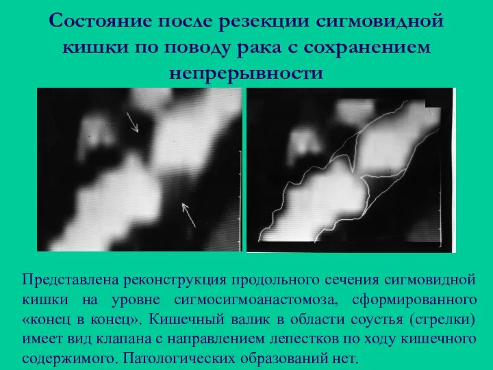 Состояние после резекции сигмовидной кишки по поводу рака с сохранением