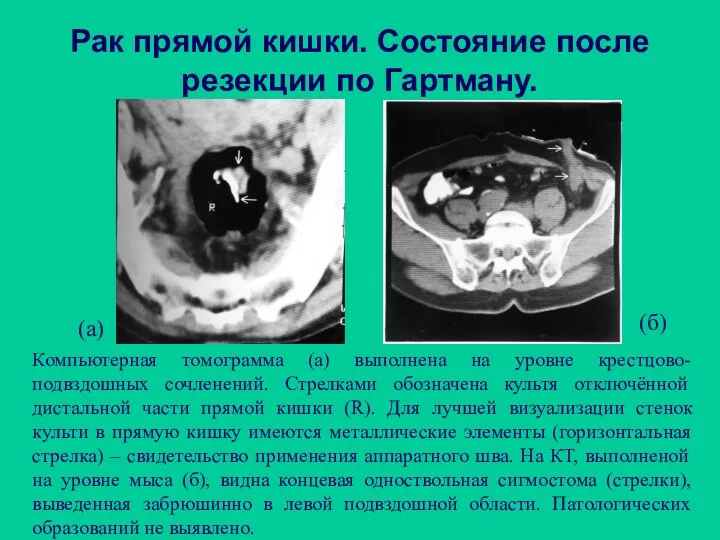 Рак прямой кишки. Состояние после резекции по Гартману. Компьютерная томограмма