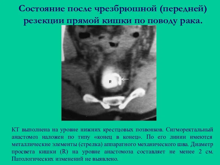 Состояние после чрезбрюшной (передней) резекции прямой кишки по поводу рака.