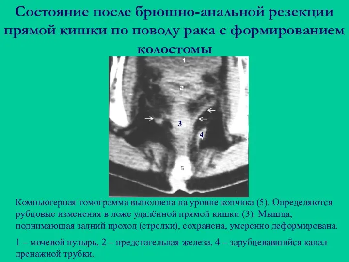 Состояние после брюшно-анальной резекции прямой кишки по поводу рака с