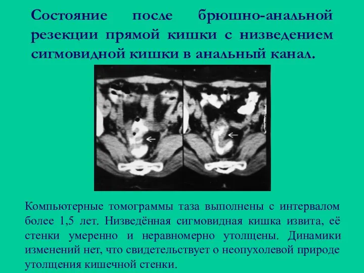 Состояние после брюшно-анальной резекции прямой кишки с низведением сигмовидной кишки