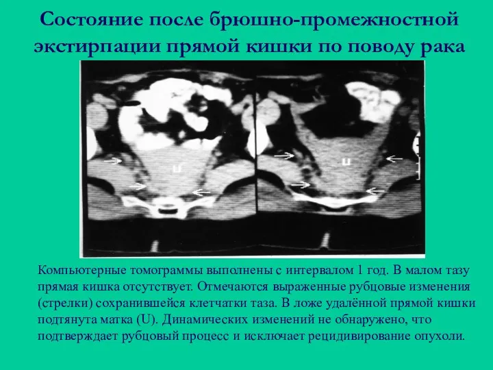 Состояние после брюшно-промежностной экстирпации прямой кишки по поводу рака Компьютерные