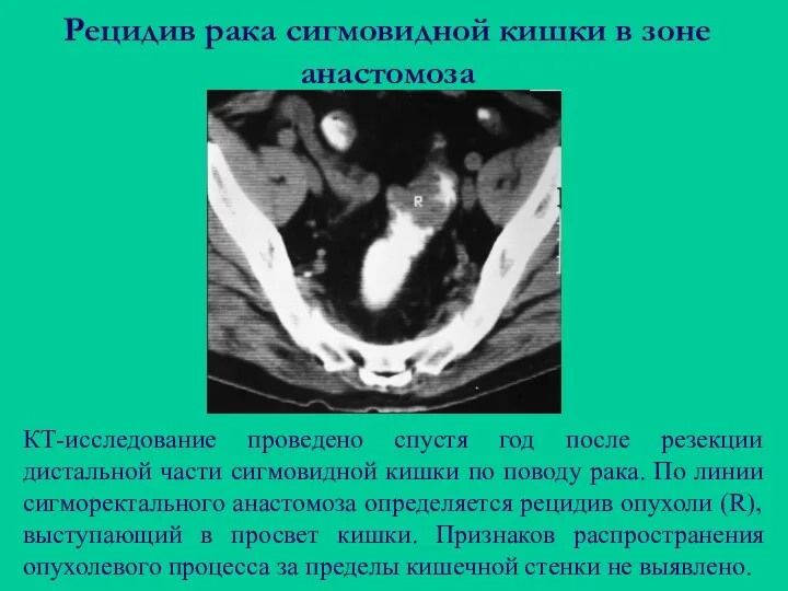 Рецидив рака сигмовидной кишки в зоне анастомоза КТ-исследование проведено спустя