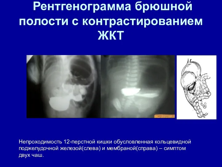 Рентгенограмма брюшной полости с контрастированием ЖКТ Непроходимость 12-перстной кишки обусловленная