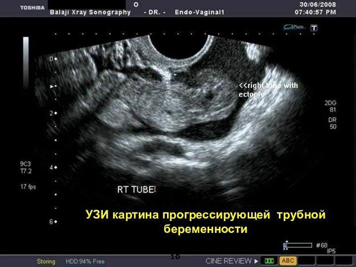 УЗИ картина прогрессирующей трубной беременности