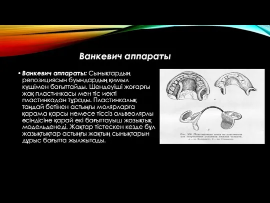 Ванкевич аппараты Ванкевич аппараты: Сынықтардың репозициясын буындардың қимыл күшімен бағыттайды.