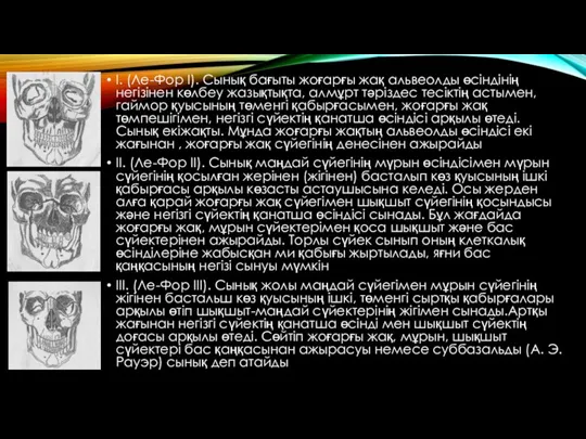 I. (Ле-Фор I). Сынық бағыты жоғарғы жақ альвеолды өсіндінің негізінен көлбеу жазықтықта, алмұрт