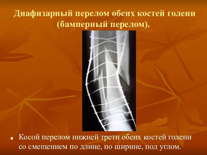 Диафизарный перелом обеих костей голени (бамперный перелом). Косой перелом нижней