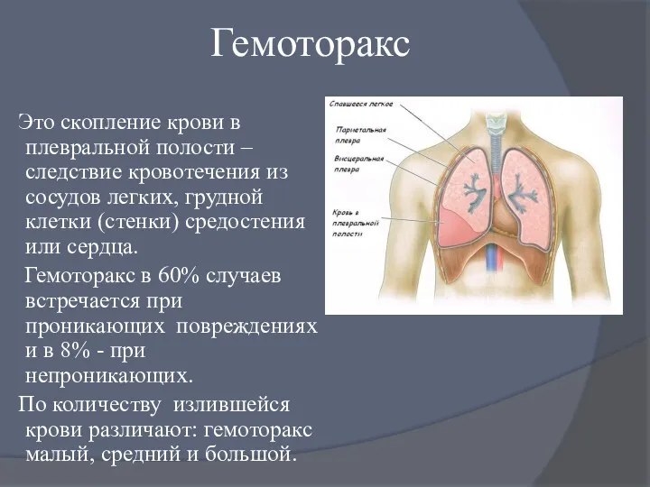 Гемоторакс Это скопление крови в плевральной полости – следствие кровотечения из сосудов легких,