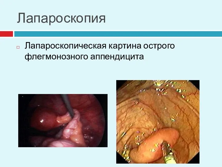 Лапароскопия Лапароскопическая картина острого флегмонозного аппендицита