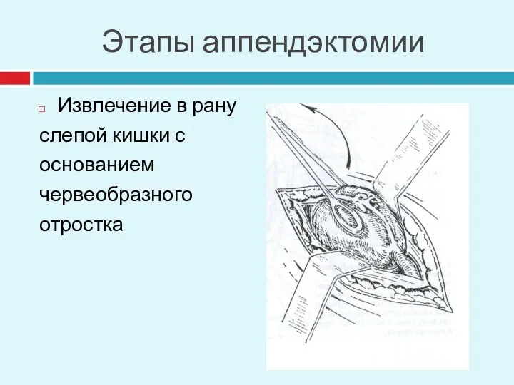 Этапы аппендэктомии Извлечение в рану слепой кишки с основанием червеобразного отростка